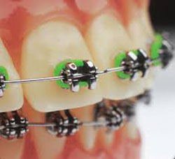 self-ligating braces